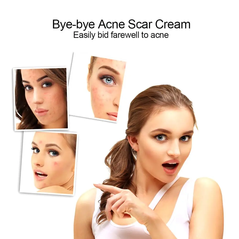 Acne Treatment Face Cream Anti Acne Scar Removal Pimple Blackhead Moisturizing Whiten Oil-control Shrink Pores Skin Care 20ML