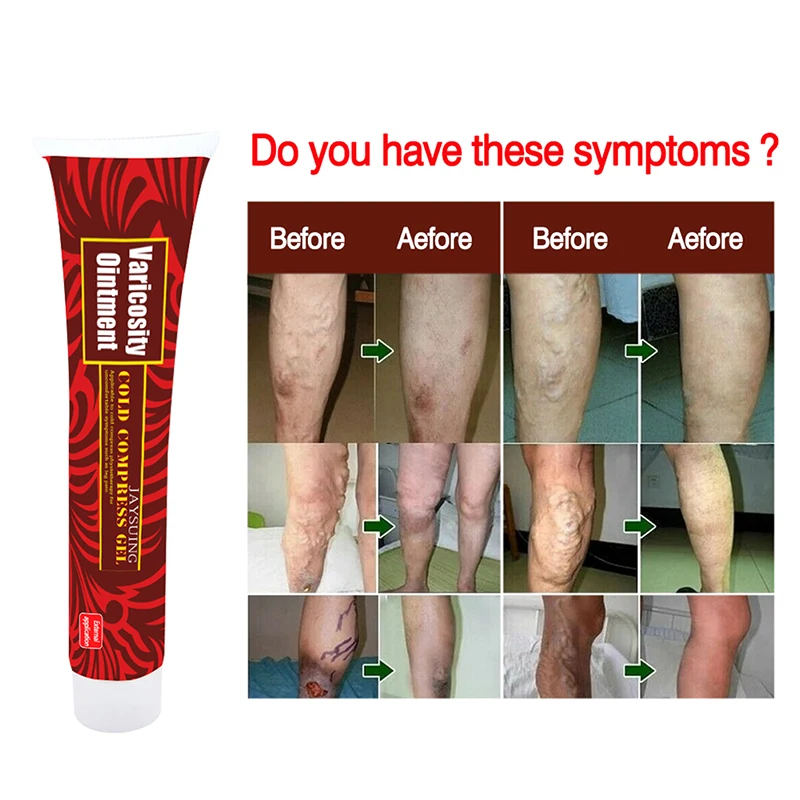 

Treatment Cream Effective cure Vasculitis Phlebitis Spider Veins Pain Varicosity Angiitis ointment Health Care