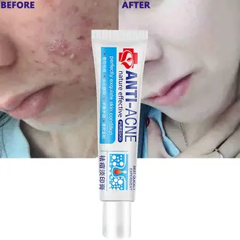 

30ml Acne Treatment Remova Anti Acne Cream Chinese Medicine Oil Control Shrink Pores Acne Scar Remove Face Care Whitening Makeup