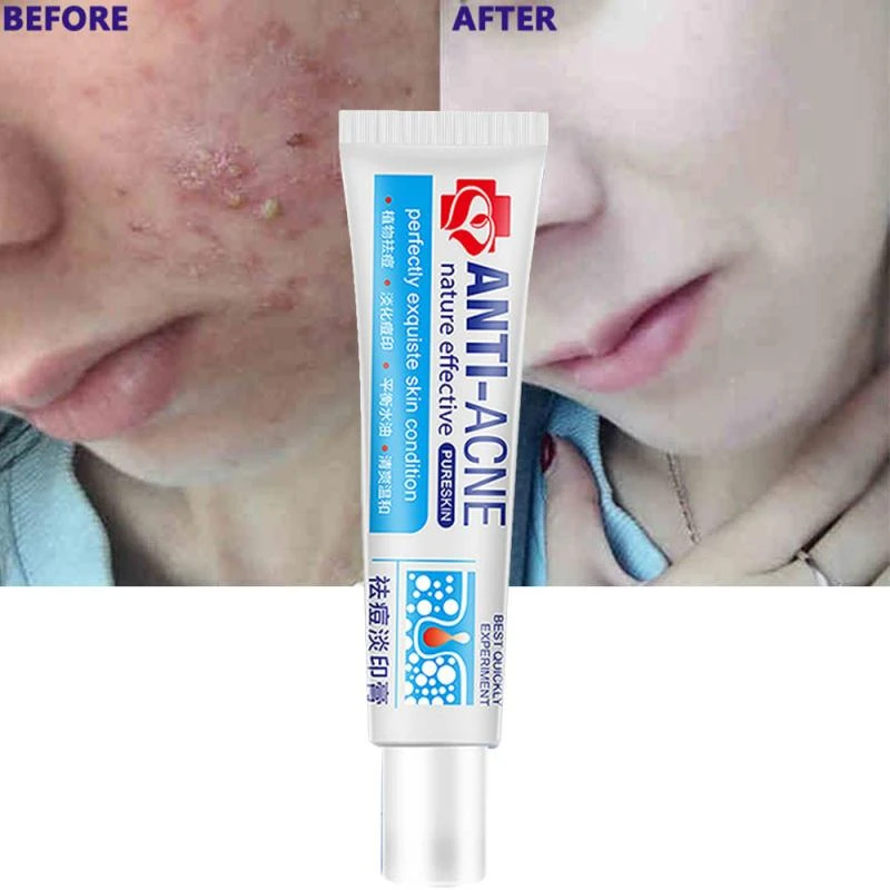 acne control medicine