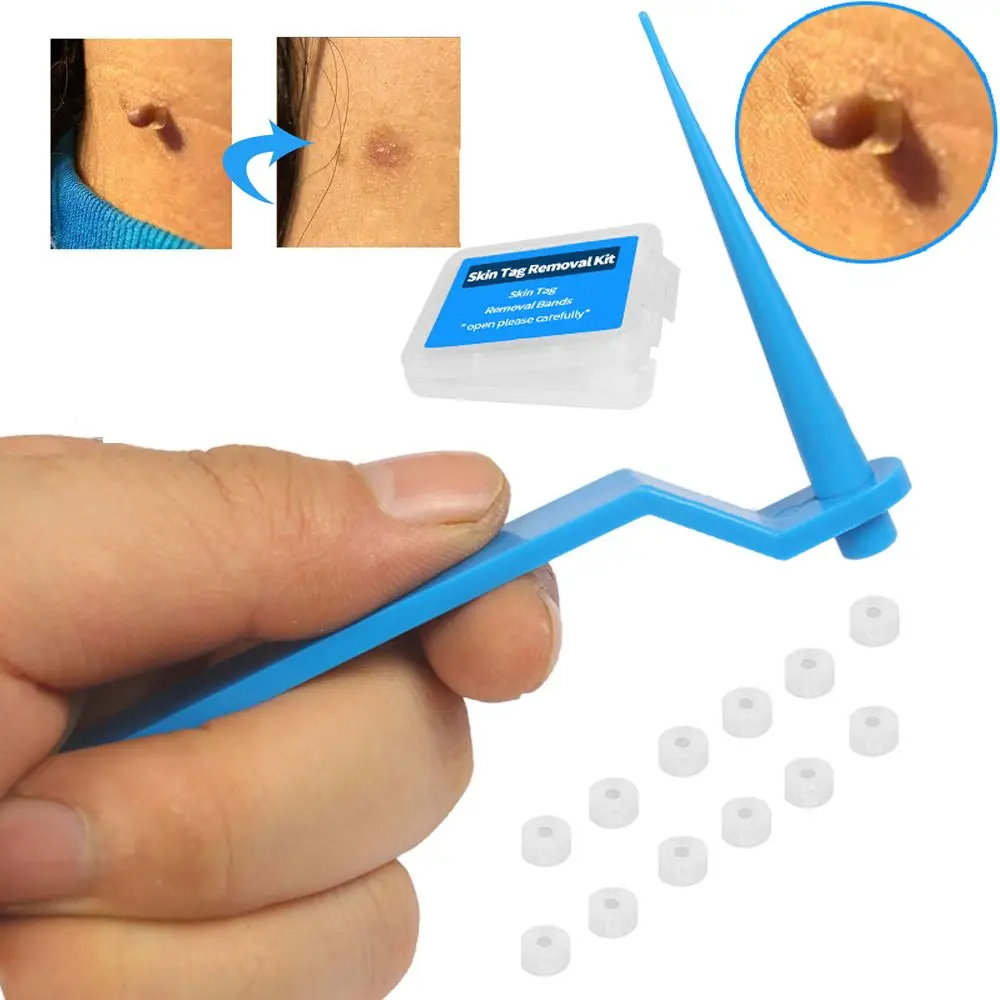 2 In 1 Skin Tag Remover Kit For 2-7mm Skin Tag Face Care Mole Wart Tool 81  Pc Skin Tag Remover Patches Facial Clean Easy To Use - Face Skin Care Tools  (none Electric) - AliExpress