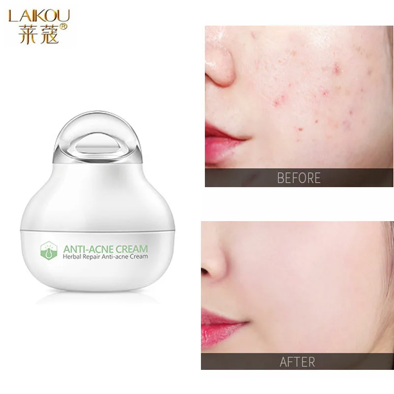 

Herbal Acne Treatment Cream Acne Scar Removal Skin Repair Moisturizing Oil Control Shrink Pores Anti Acne Whitening Skin Care