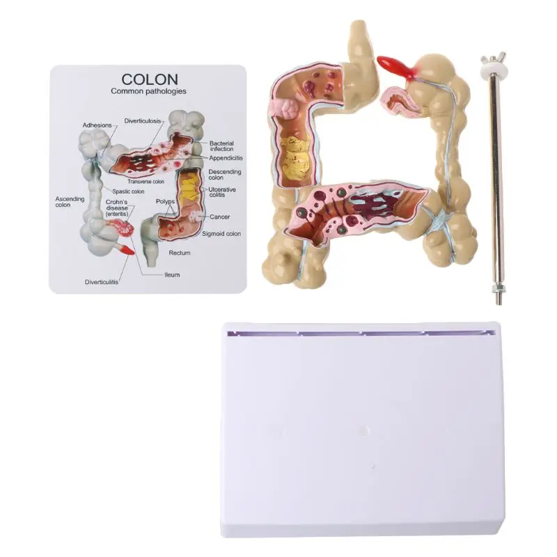 

Human Colorectal Lesion Model Pathological Anatomy Colon Diseases Intestine Medical Teaching Learning Tool 19QA
