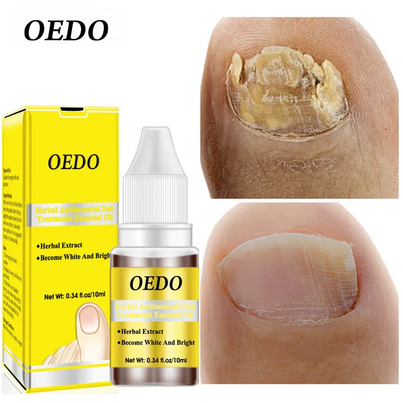 OEDO Fungal Nail Repair Essence Herbal Anti Fungus Treatment Onychomycosi Paronychia AntiFungal