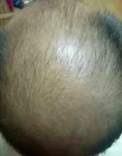 Sevich-espray de esencia para el crecimiento del cabello para hombres y mujeres, tratamiento para la pérdida del cabello, nutre las raíces, fácil de llevar, cuidado del cabello Germinal rápido, 30g