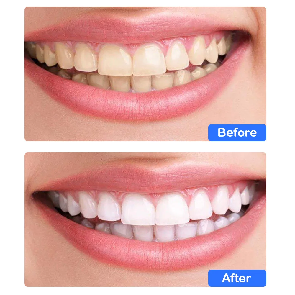 28pcs 3D Advanced White Gel Teeth Whitening Strips Stain Removal Oral Hygiene Care Double Elastic Teeth Strips Bleaching Tools