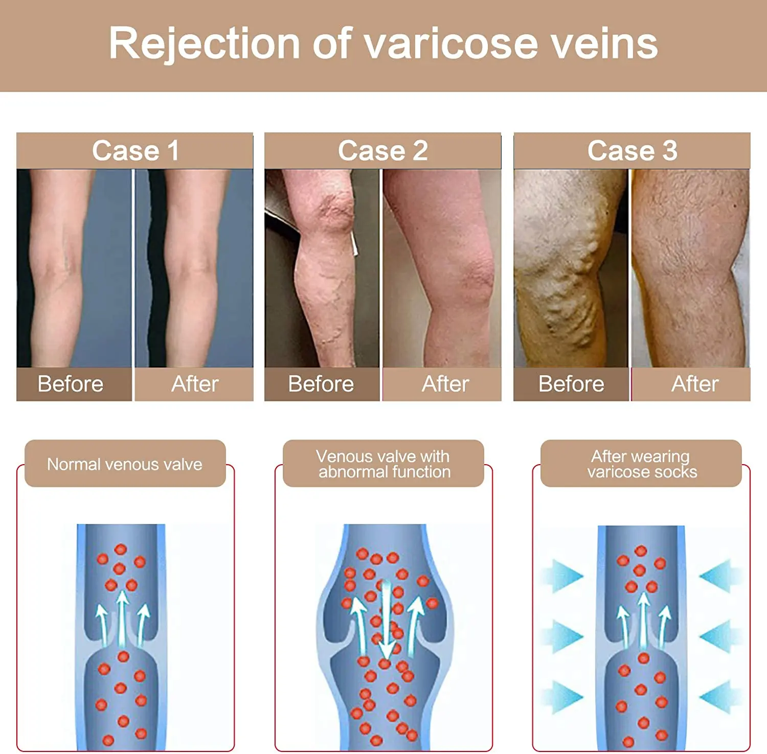 Medical Stocking Compression Stockings Women 20-30 mmHg Graduated Support Socks DVT Maternity Pregnancy Varicose Veins
