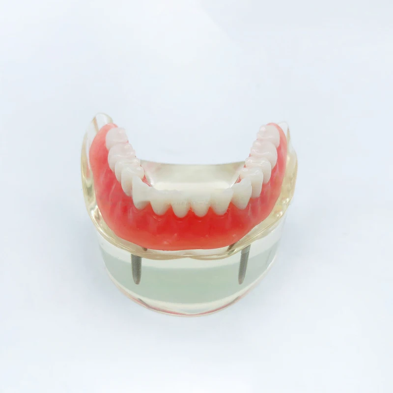 1 шт. Стоматологическая модель исследования зубов Overdenture низший 2 имплантата демонстрационная модель