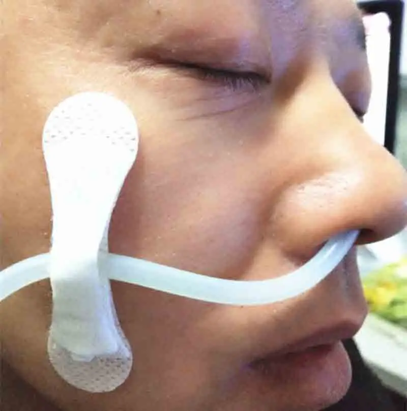 Medical stomach tube feeding tube fixation Body surface fixture Stomach tube fixed nasal feeding tube fixed sterile paste