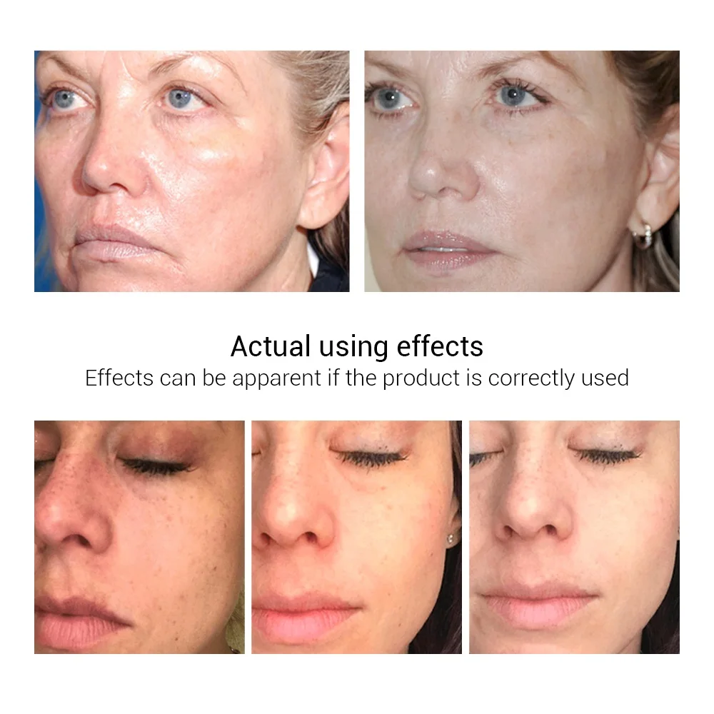 LANBENA Repair Whitening Essential Oil Hyaluronic Acid Vitamin C Serum Remove Acne Firming Skin Care Moisturizing Dry Nourish LANBENA Repair Whitening Essential Oil Hyaluronic Acid Vitamin C Serum Remove Acne Firming Skin Care Moisturizing Dry Nourish