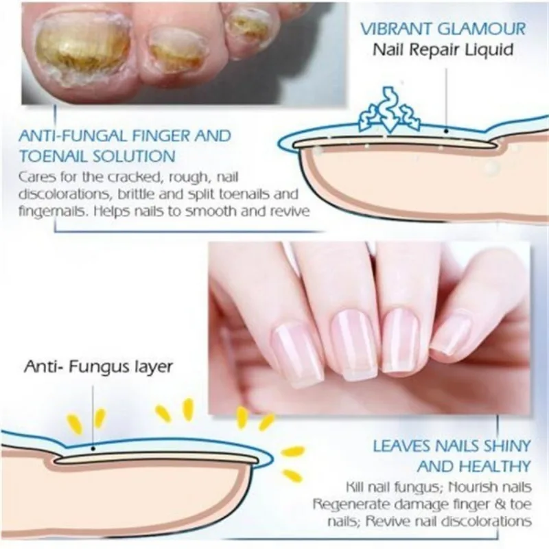 Антигрибковая жидкость для дезинфекции ногтей бактериостатический Восстанавливающий раствор для ногтей Удаление грибка гель анти-инфекция
