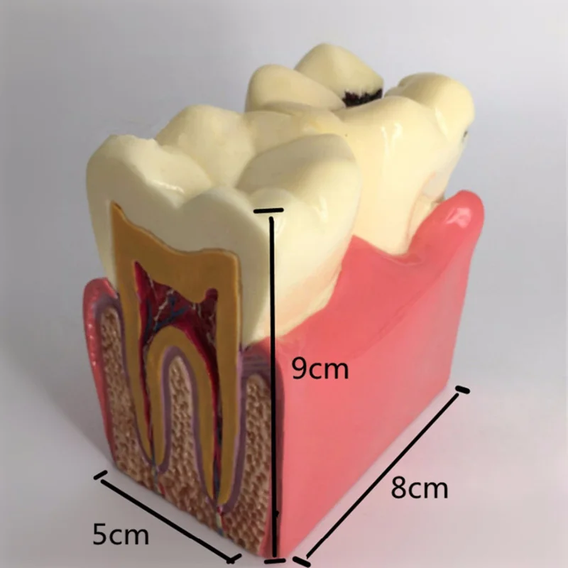 Kopen 1 stuks dental tanden model 6 Keer Cariës Comparation Studie kunstgebit Tand modellen Tandarts Studeren en Onderzoek Tandheelkunde product
