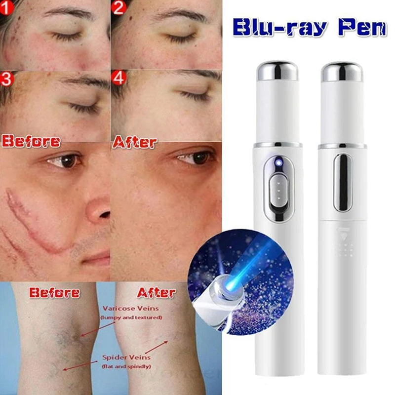 Blue Light Therapy Pen For Varicose Veins Wrinkle Acne Laser 1Pcs | Красота и здоровье