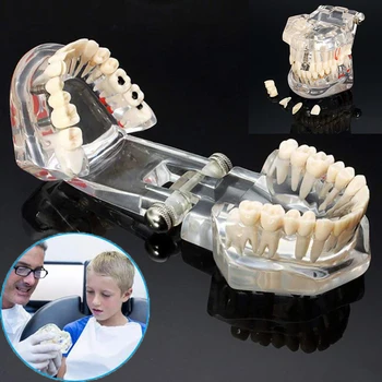 

Dental Implant Disease Teeth Model With Restoration Bridge Tooth Model For Dentistry Teaching Tools Dentist Medical Material