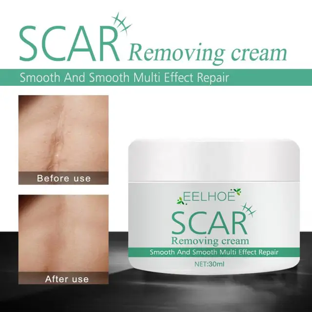 EELHOE® Scar Removal Cream Facial Burn Scars Surgical Hyperplasia Bump