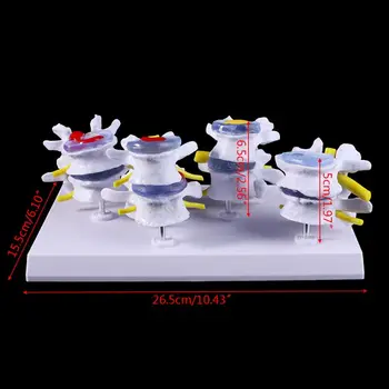 

1 Set Human Lumbar Lesion Spine Statue Display Model Medical Teaching Learning Tool Y98A