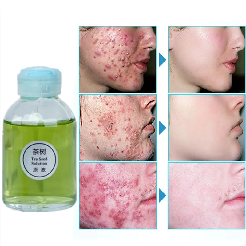 

Tea Tree Cleansing Acne Essential Oil Shrink pores Face Anti acne Treatment Cream Moisturize Nutrition Control Oil Smooth Skin