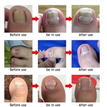 Дизайн ногтей вросший корректирующий стикер фиксатор Paronychia восстановление ногтей эластичная заплатка корректор для педикюра инструмент 10 шт