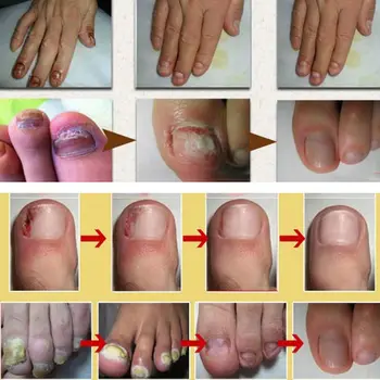 

Chinese Medicine Herbs Toe Nail Fungus Treatment Anti Fungal Nail Infection X7JA