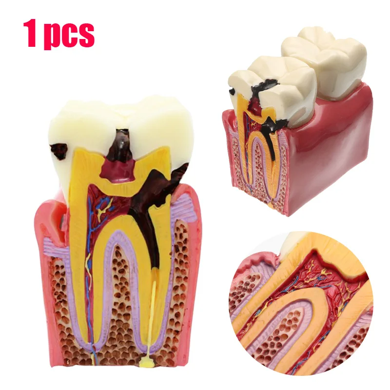 

1pcs Caries Teeth Model 6 Times Caries Comparation Study Models Tooth Decay Model Denture Teeth Model For Dental Study Teaching