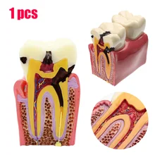 1pcs Caries Teeth Model 6 Times Caries Comparation Study Models Tooth Decay Model Denture Teeth Model For Dental Study Teaching