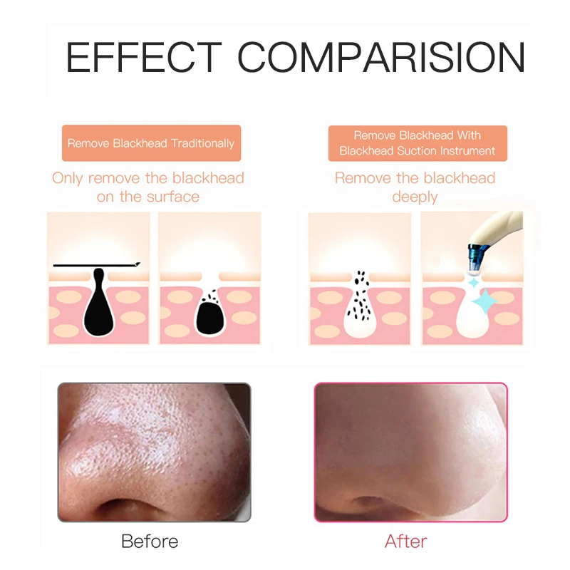 ROSALIND средство для удаления угрей лица глубокое ухода за кожей пор вакуумное