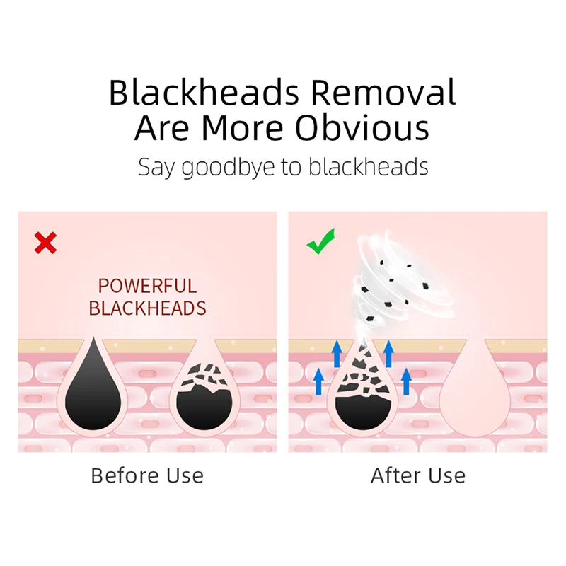 Electric-Vacuum-Suction-Blackhead-Remover-Black-Head-Pimple-Removal-Nose-Facial-Pore-Cleaner-Beauty-Face-Skin (3)