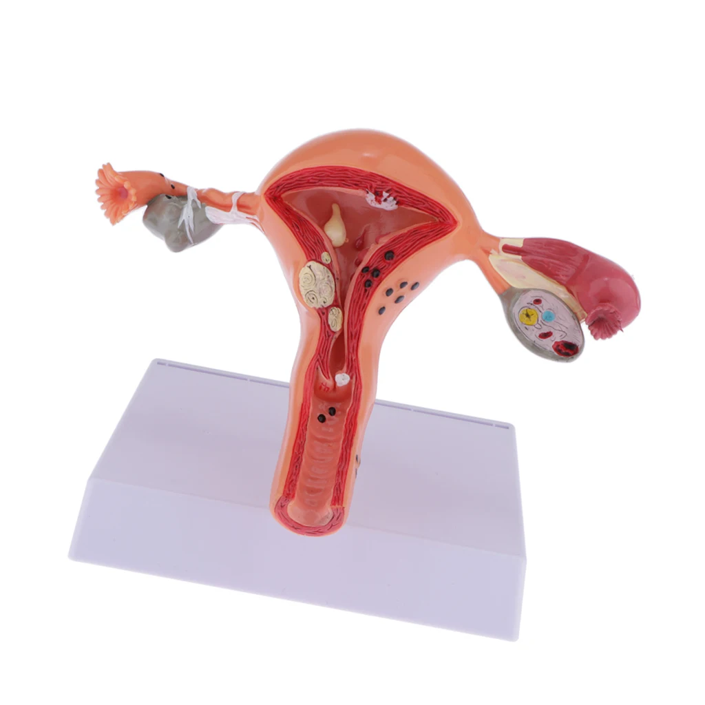 Human Female Uterus Ovary Anatomical Model With Pathologies, 1:1 Life Size, Lab Supplies Decoration