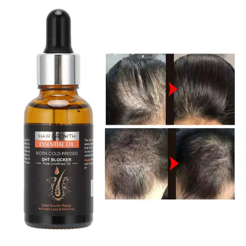 Hair Growth Oil Prevent Hair Loss Thinning Deep Nourish Serum Repair Hair  Follicles Anti Frizz 30ml - Hair Loss Product Series - AliExpress