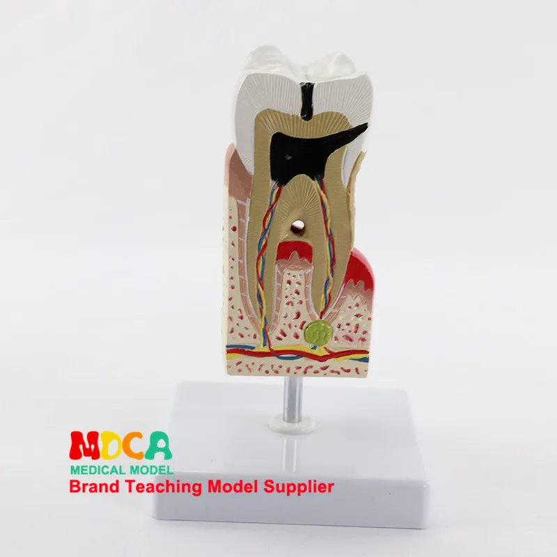 

Tooth Pathological Anatomical Model Cavities Amplifier Teeth Caries. Tooth Gingival Show Medical Teaching Model Myc010