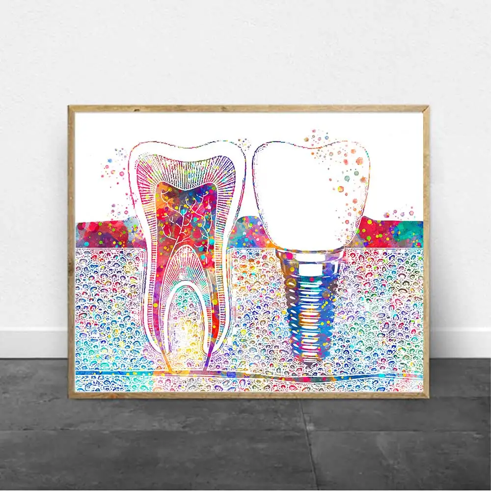 Dental Tooth Implant Canvas Painting Print Dentist Wall Art Picture