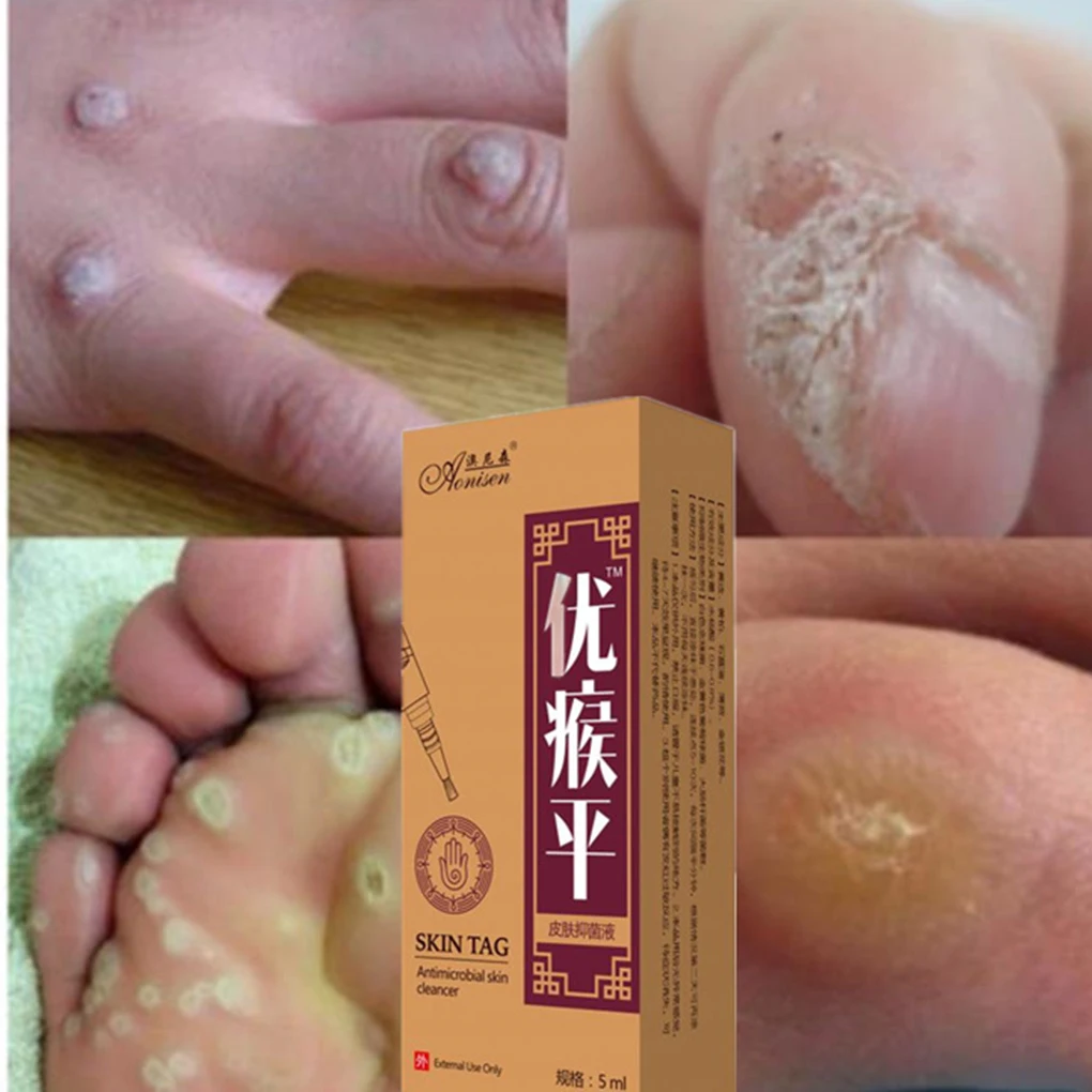Body Warts Treatment Cream Chinese Medicine Treatment Foot Corn To Remove Plantar Warts Medical Plaster Ointment Warts Removal Foot Care Tool Aliexpress