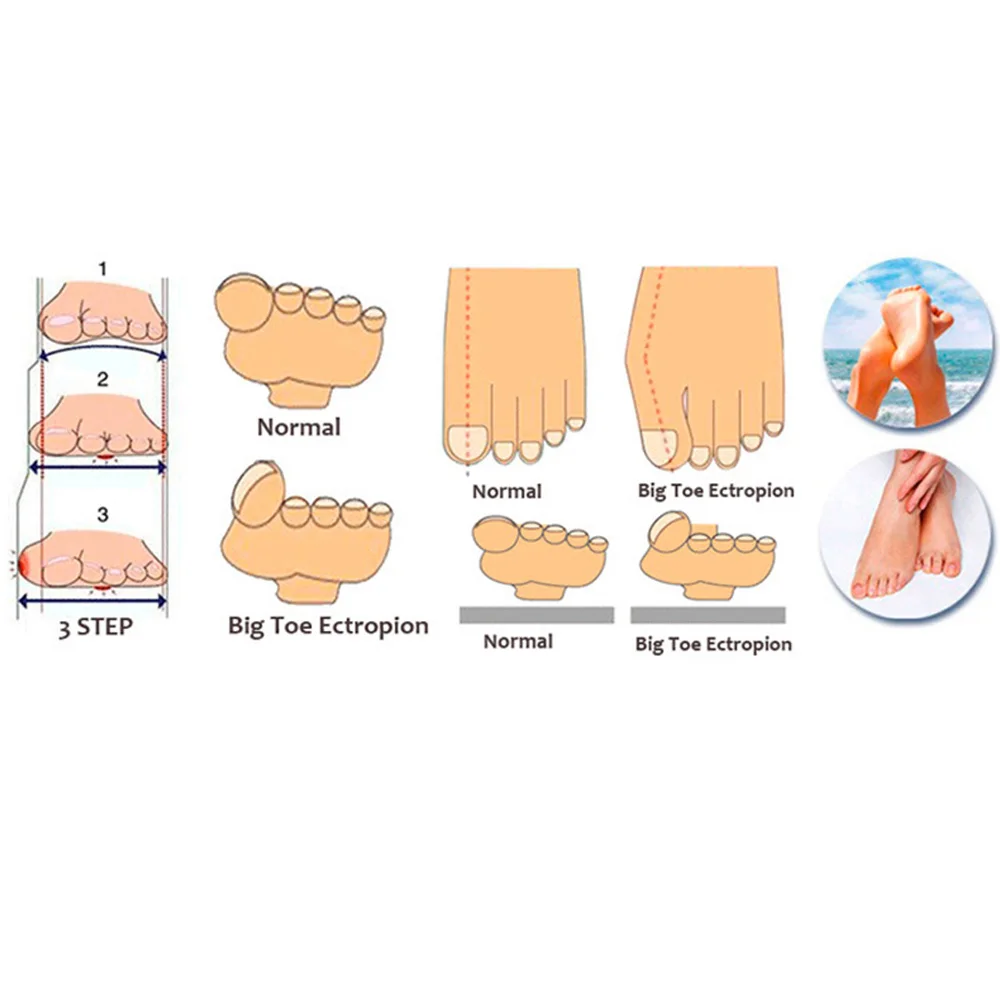 1 пара Bunion Hallux вальгусная деформация защитный гель крышка рукава трение пальцев ног протекторы мягкий уход за ногами