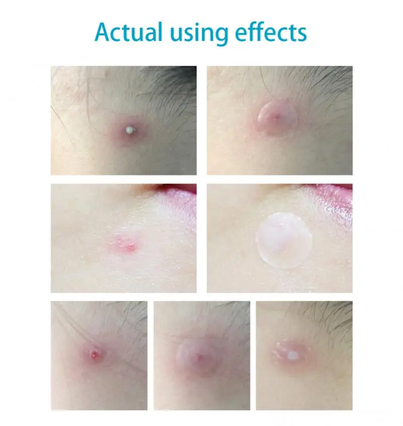 Acne Remover 25pcs/28pcs Day + Night Tea Tree Extract Acne Removal Pimple Patch Invisible Stickers Acne Pimple Removal TSLM1