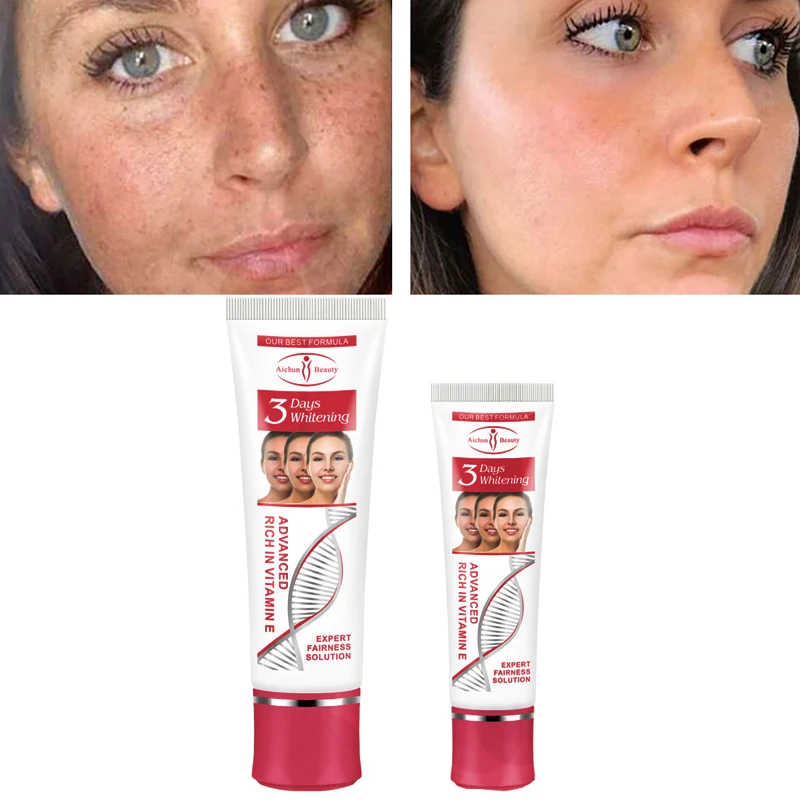 cream for freckles and age spots