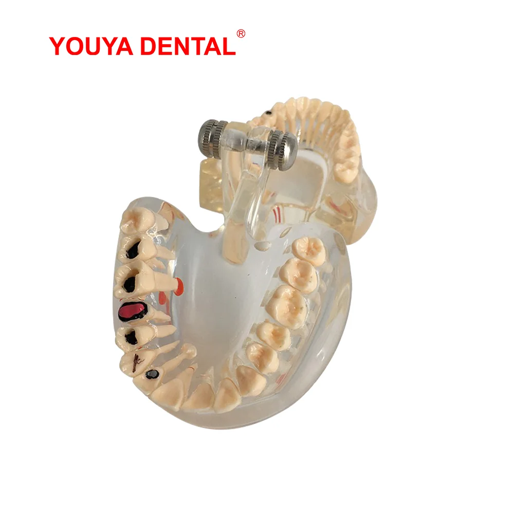 치과 교육용 투명 치아 모형 성인 병리학 의학 과학 구강 치과 제품