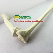 

Orthopedic preoperative bone grafting femoral tibia osteosynthesis