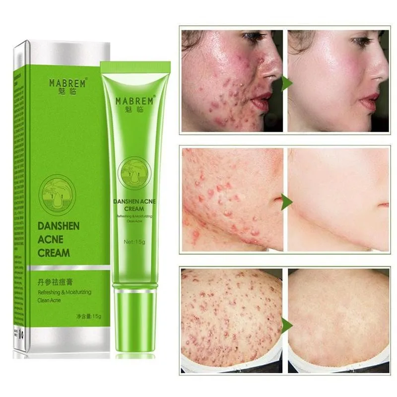 Miltiorrhiza Acne Cream Removal Treatment Oil Control Shrink Pores Whitening Moisturizing Skin Care | Красота и здоровье