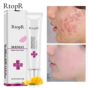 

Useful Mango Acne Treatment Face Cream Blackhead Repair Gel Oil Control Shrink Pore Scar Whitening Moisturize Skin Care Cosmetic