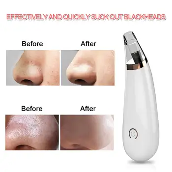 

Deep Clean Acne Remover Dead Skin Acne Removing Apparatus Face Cleaner 3 Treatment Heads Black Head Removal Pores Cleaner