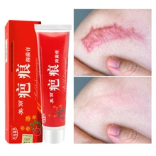 

Acne Scar Removal Cream Pimples Face Gel Stretch Marks Remove Acne Smoothing Whitening Moisturizing Body Skin Care Body Cream