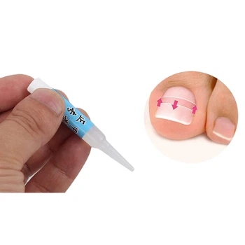 

Nail Glue Ingrown Toenail Correction Pedicure Toe Patch Adhesive Foot Care Tool