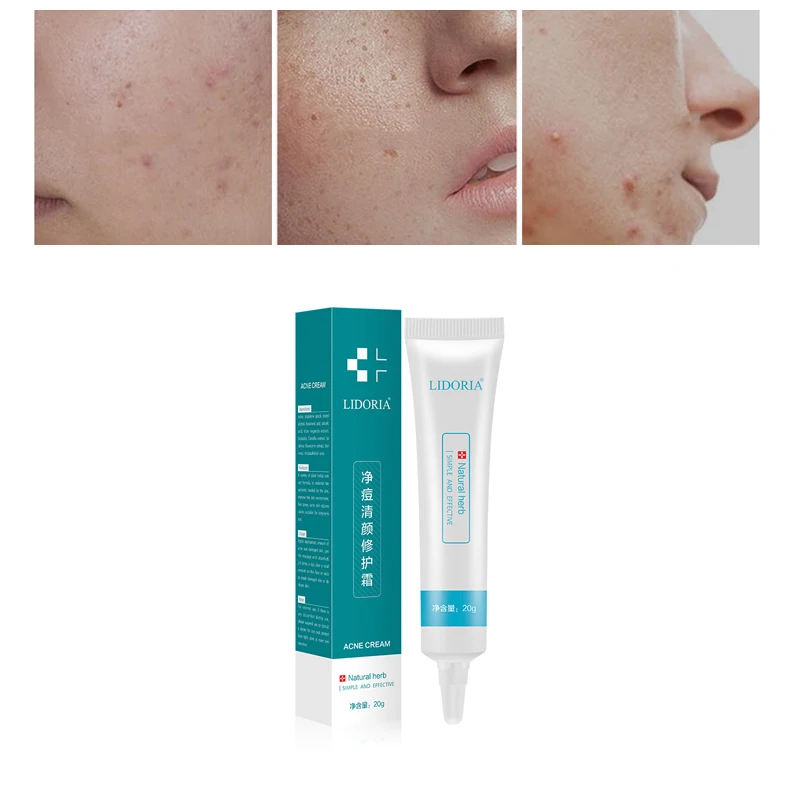 

LIDORIA Spot Acne Treatment Remover Cream Anti Acne Cream Oil Control Shrink Pores Acne Scar Remove Skin Repair Skin Care TSLM2