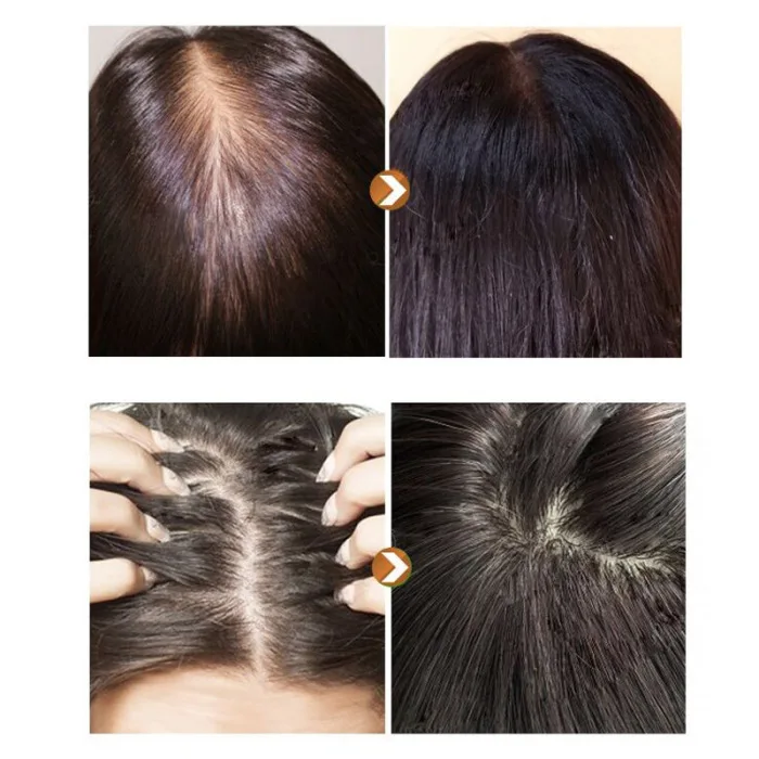 Горячая 1 Набор Уход за волосами эссенция масло Предотвращение выпадения волос эффективное питает для женщин мужчин CUN 668