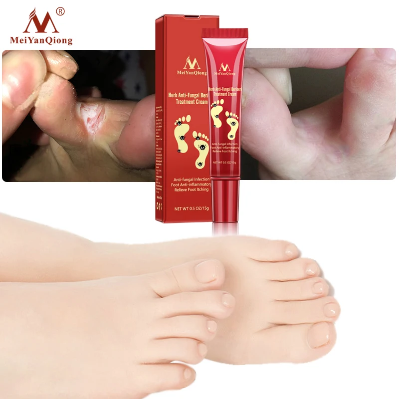 Herbal Foot Treatment Anti Fungal Infection Onychomycosis Paronychia Effective Toe Fungus Treatment Feet Repair Cream foot care5