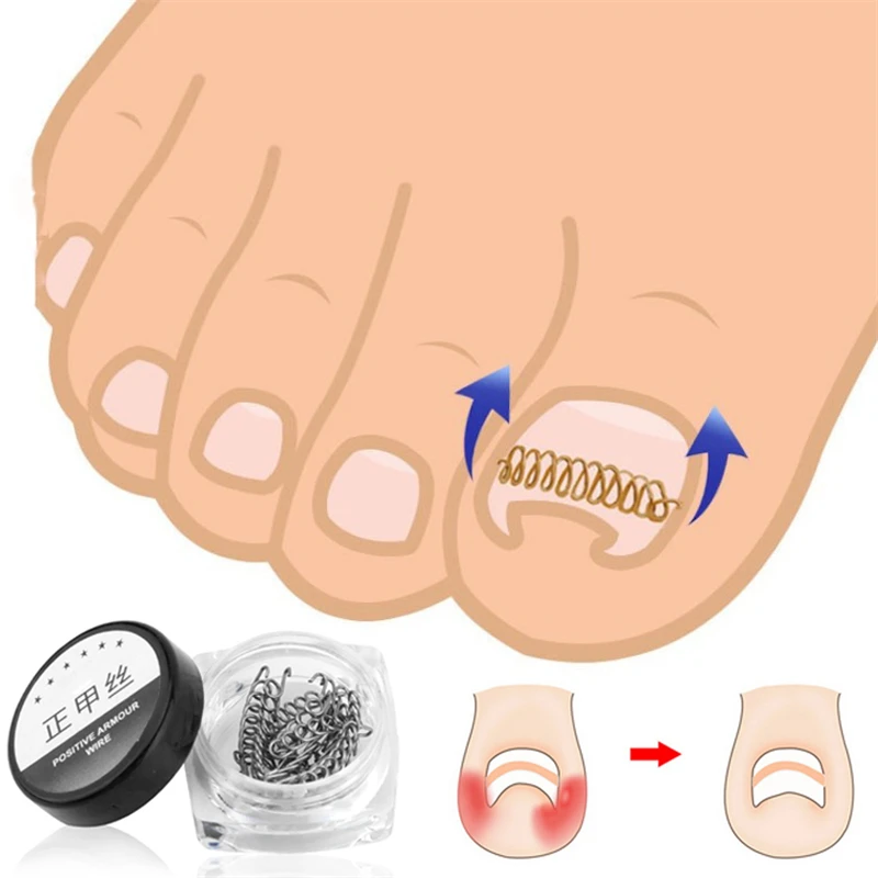 

12pcs/box Nail Art Ingrown Toenails Correction Wire Fixer Recover Care Paronychia File Patch Corrector Foot Pedicure Tools