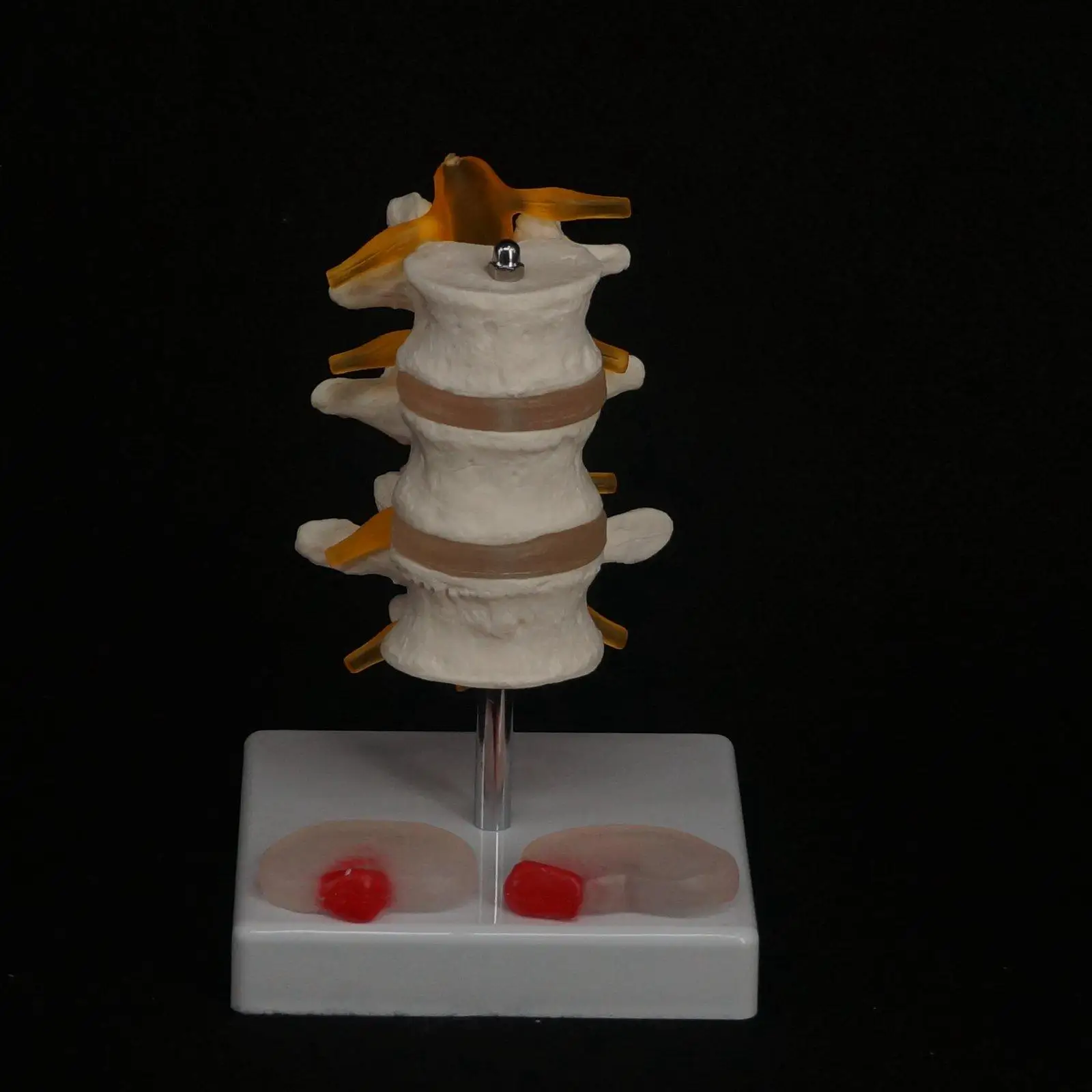 Human Three Lumbar Lesions Intervertebral Disc Skeleton Spine Medical Model | Канцтовары для офиса и дома
