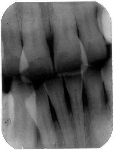 Стоматологическая рентгеновская портативная Мобильная машина для визуализации пленки цифровая система низкой дозы BLX-5