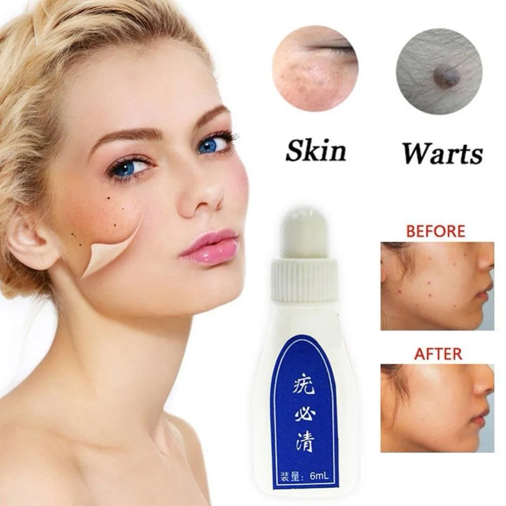 

6ml Liquid Painless Mole Skin Dark Spot Removing Face Wart Tag Freckle Removal Cream Oil Mole Skin Tag Beauty Tool Chinese Balm