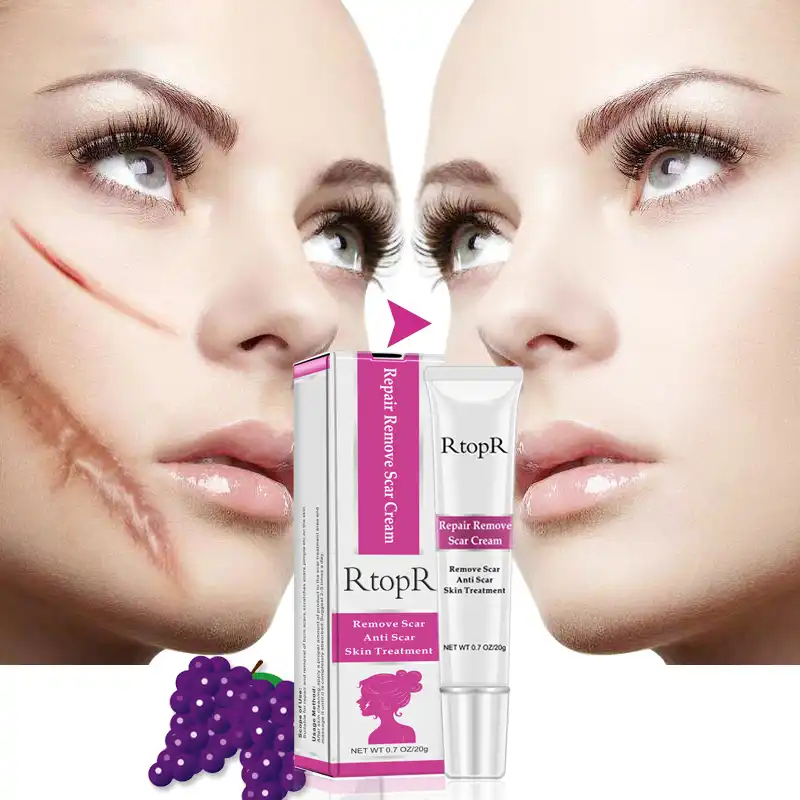 cream to remove marks on skin
